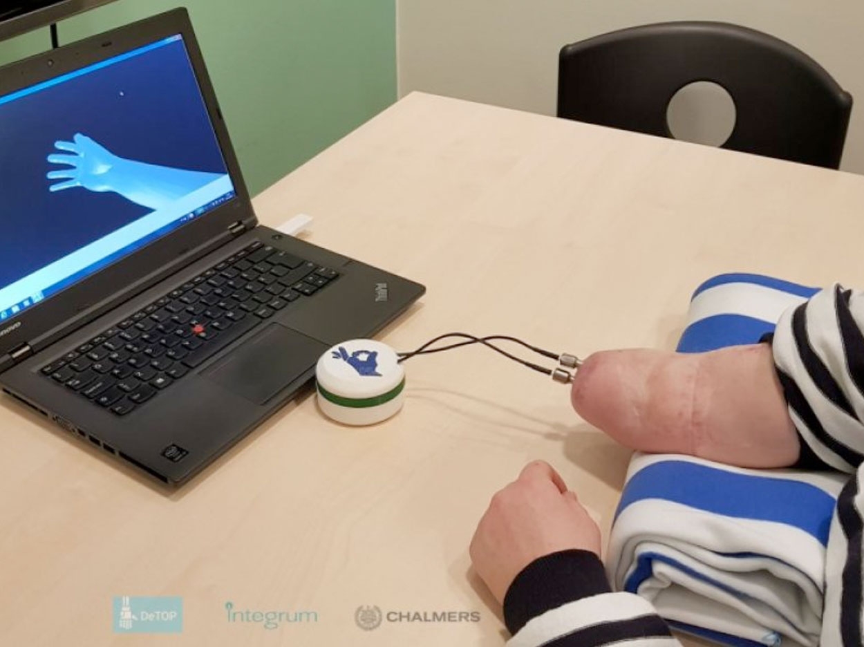 The first person with below-elbow amputation implanted with an osseo-neuromuscular prosthesis. Electrodes implanted in nerves and muscles are accessed via two titanium implants that serve for skeletal attachment and communication interface with the prosthesis. The prosthesis is virtual during the recovery period after surgery to evaluate the interface. Credit: Dr. Max Ortiz Catalan