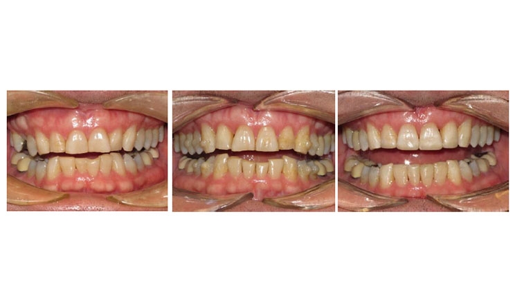Figure 1: This case of extensive anterior wear was treated with nonsurgical crown lengthening of the mandibular incisors using dentoalveolar intrusion (DAI) and conservative resin restorations.