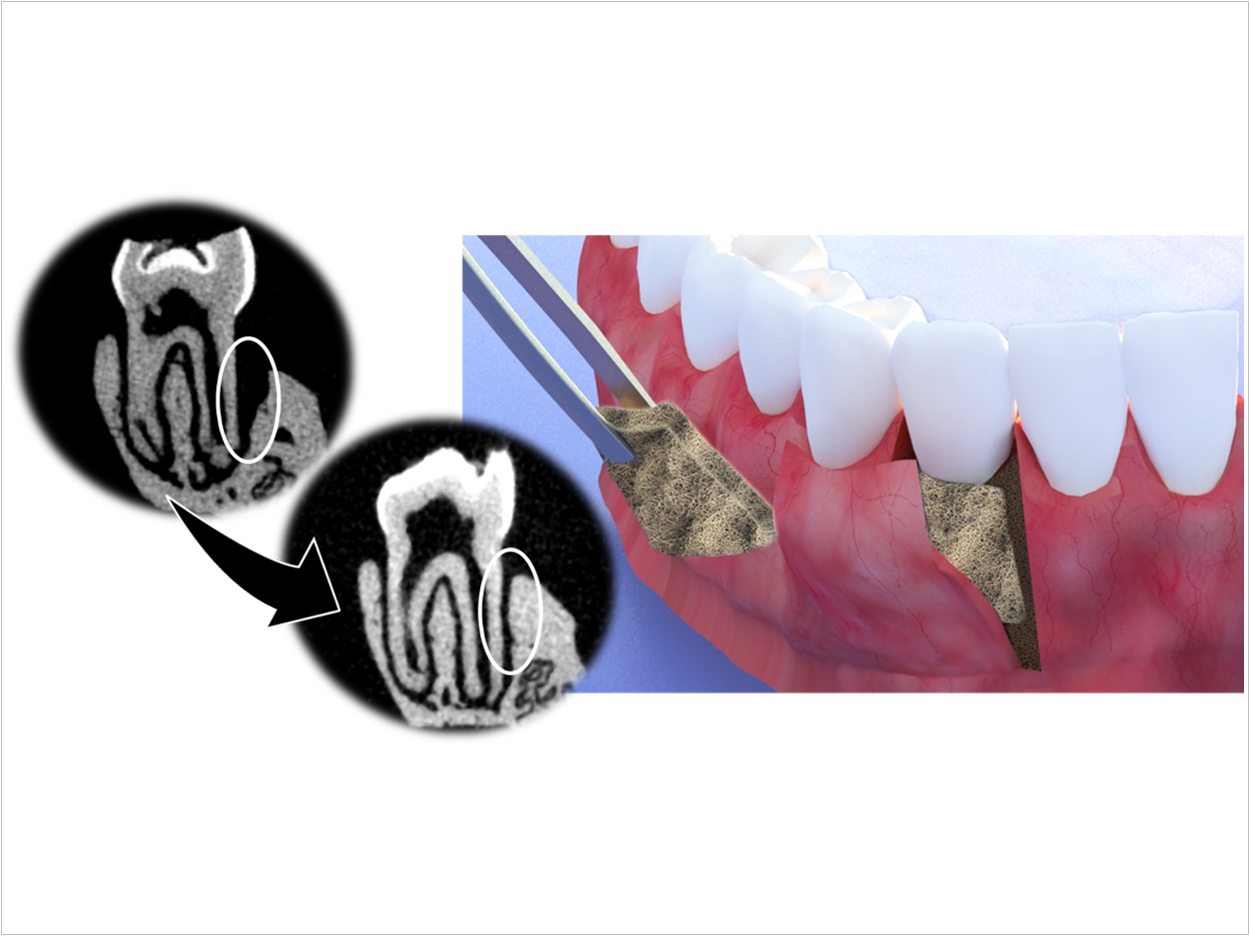 A multifunctional periodontal membrane is surgically inserted into the pocket between affected gums and tooth. This new membrane has shown to protect the site from further infection as well as to help regrow bone. Credit: Dr. Mahdi Hasani