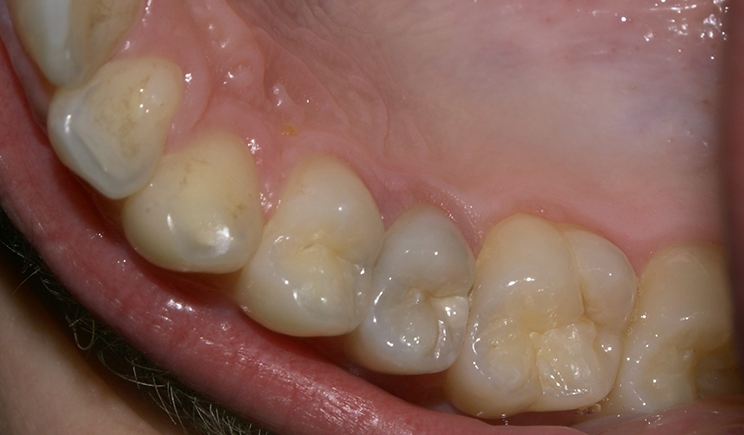 Figure 1. Mirror cavities could be found on the upper second premolar and upper first molar. The enamel structure was well preserved.