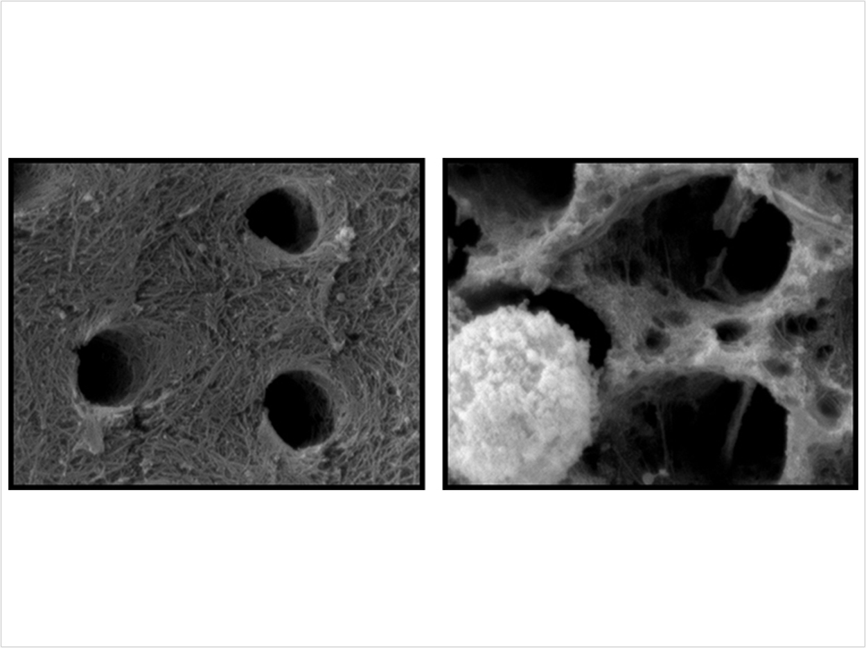 Collagen after incubation with neutrophils for 24 hours: Image at right depicts a loss of collagen fibril network when incubated with neutrophils. Courtesy of Russel Gitalis.