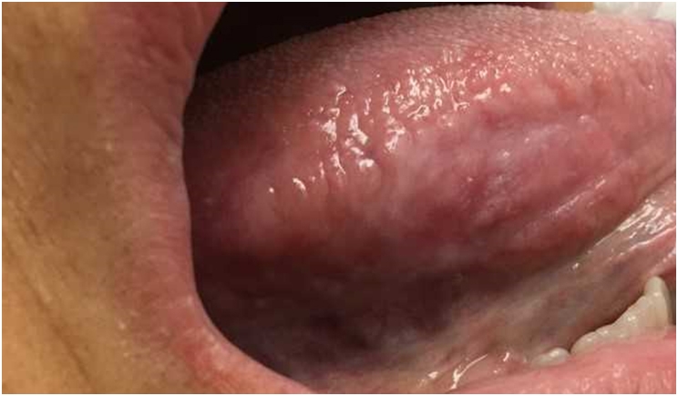 Figure 1: A thin, faint leukoplakia of the right lateral tongue. A slight granular appearance can be seen at the inferior aspect of the lesion. Biopsy revealed severe epithelial dysplasia.