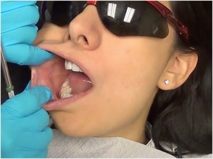 Photo courtesy of the Oral Cancer Foundation.