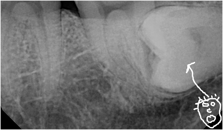 Figure 1: The patient had cracked tooth syndrome as well as a mesially impacted wisdom tooth.