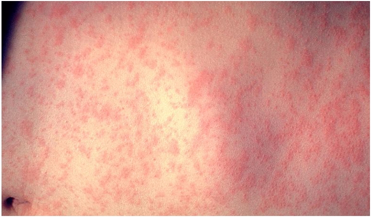CDC/Dr. Heinz F. Eichenwald