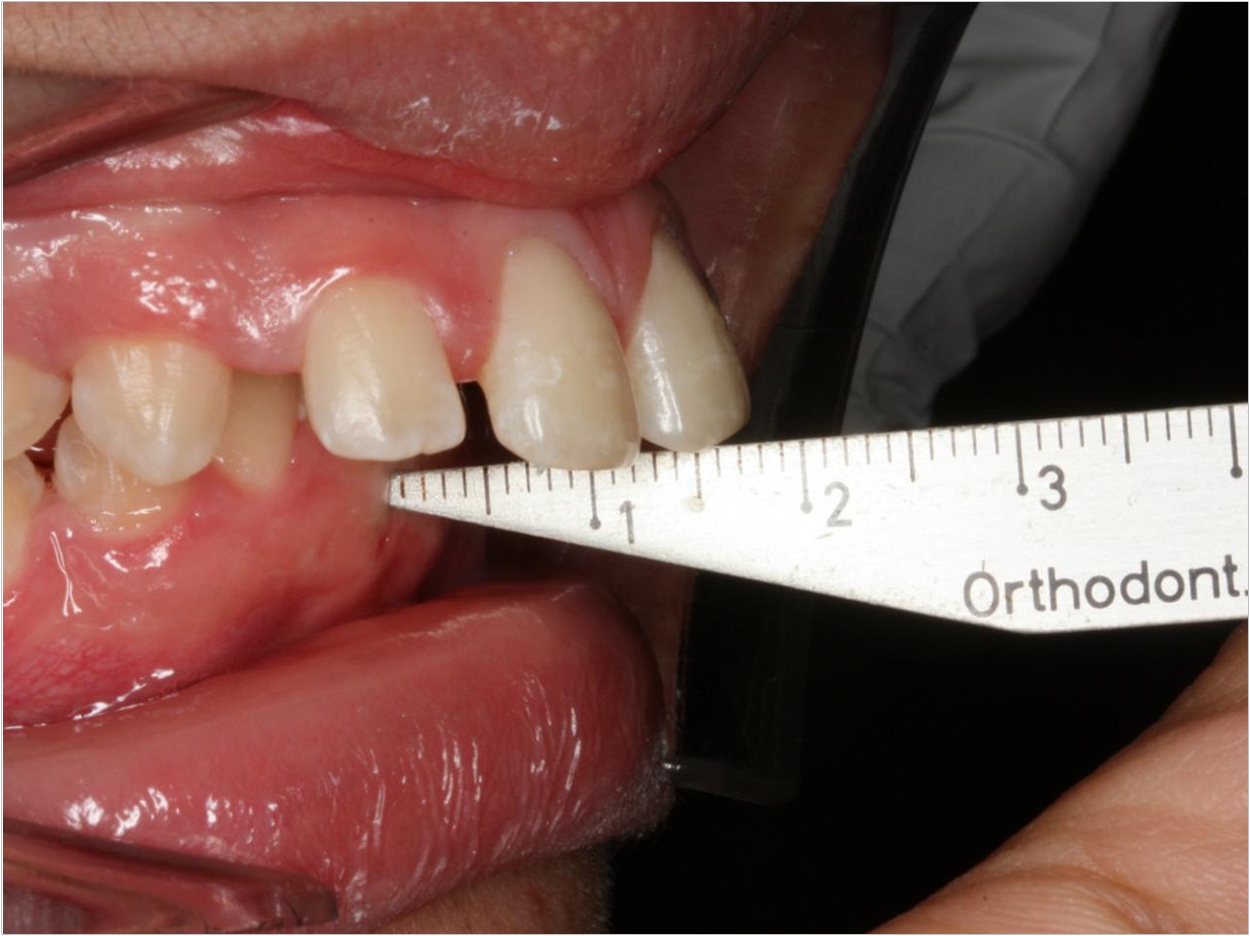 Children with their first or early adult set of teeth that stick out have an increased chance of damaging them, but the risk can be easily reduced without being prohibitively costly. The University of Adelaide