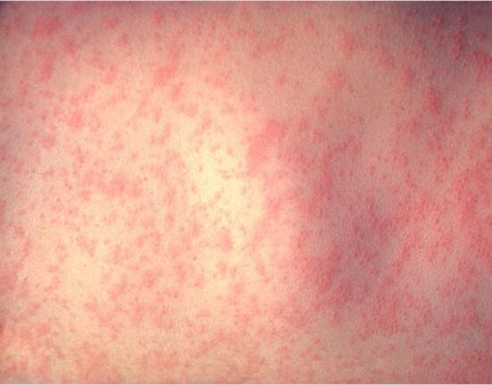 CDC/Dr. Heinz F. Eichenwald