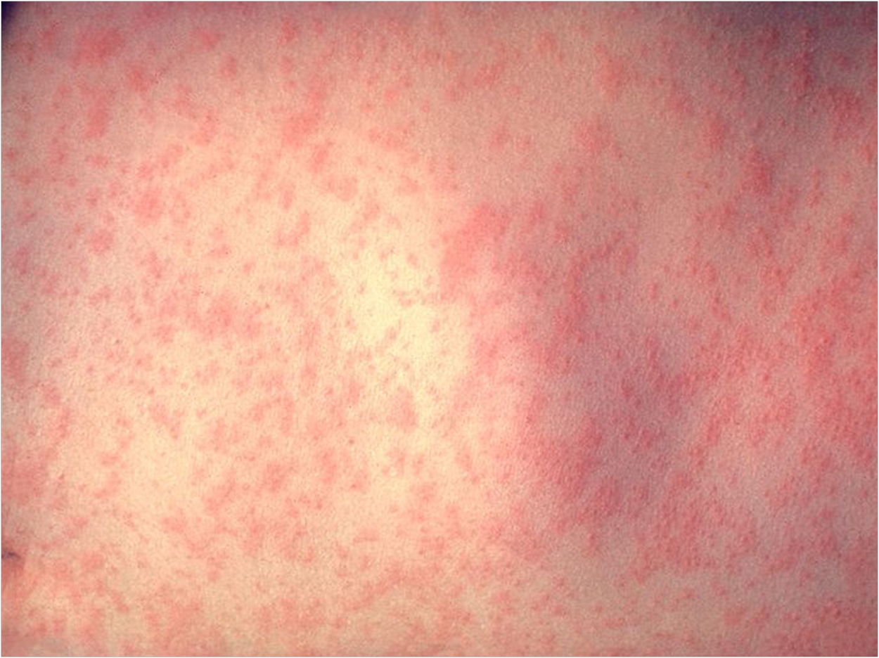 CDC/Dr. Heinz F. Eichenwald