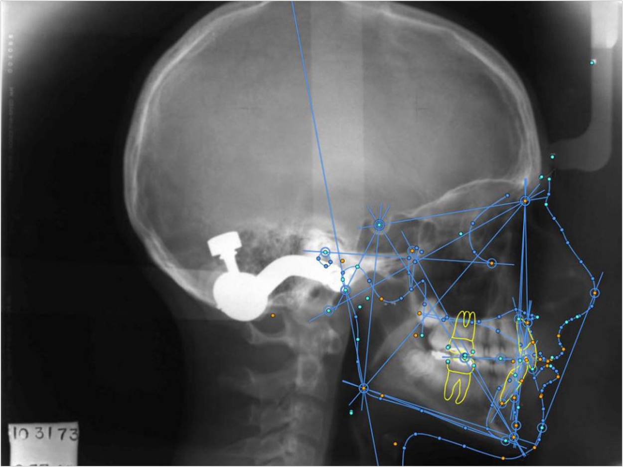The dots on this x-ray represent landmarks that are automatically identified, labeled, and measured within seconds using OrthoDx. Courtesy of Melih Motro