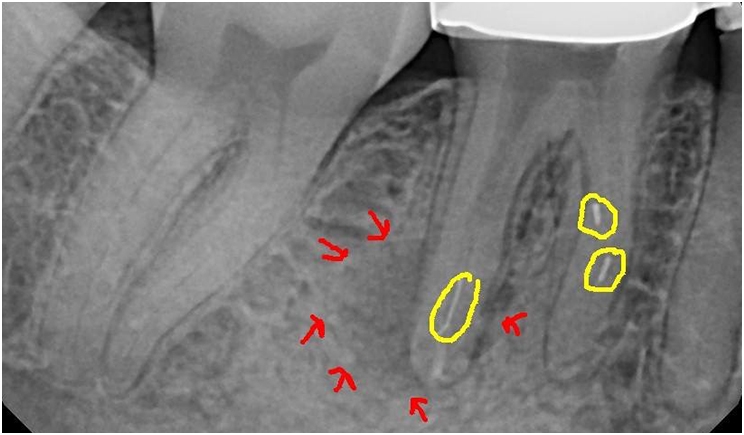 Figure 1: The patient presented with three separated instruments and canal transportation.
