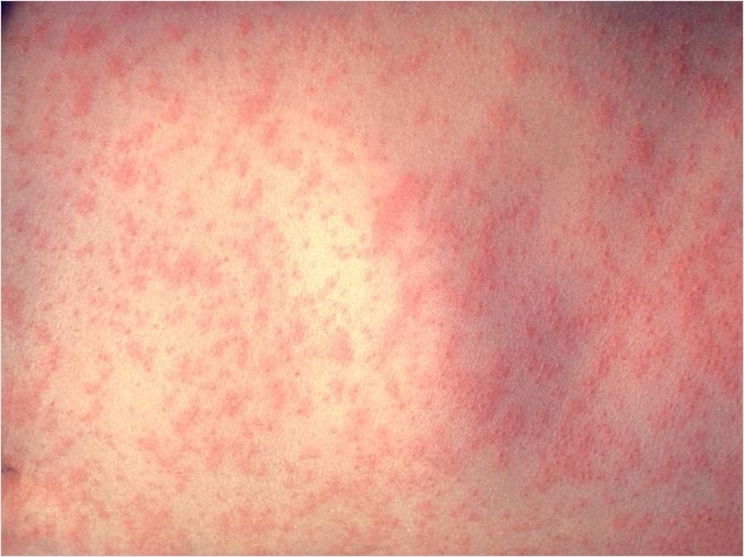 CDC/Dr. Heinz F. Eichenwald