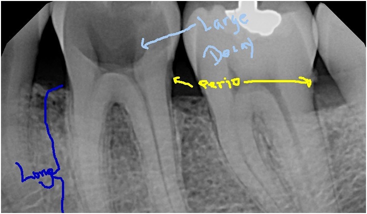 Figure 1: Despite deep decay, perio issues, and long and skinny roots, there was enough space for a crown without invading the biological width.