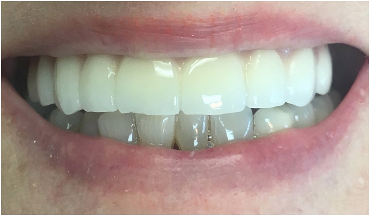 Figure 1: The prosthesis does not provide any indication of where the screw accesses are located.