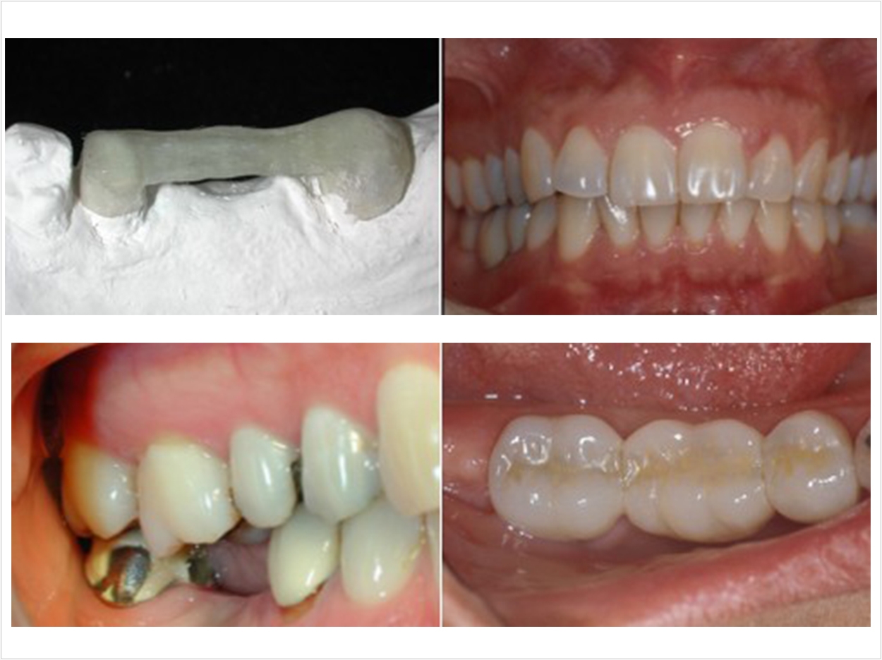 A clinical case successfully treated by Ayman Ellakwa using polyethylene fibers (top). Clinical case where failed porcelain fused to metal bridge is replaced with fiber-reinforced dental composite bridge (bottom).