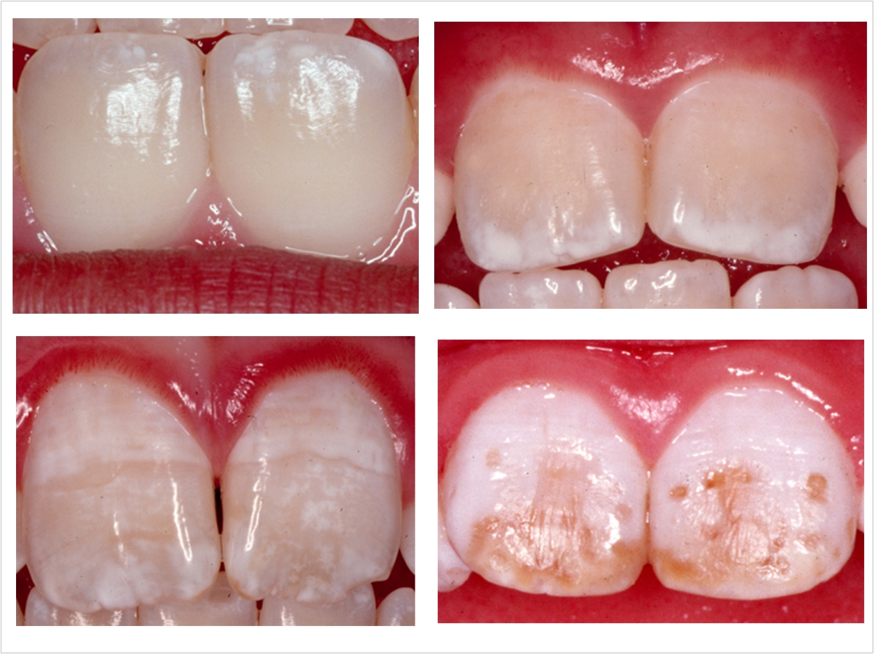 Dental fluorosis cases ranging from very mild to severe. Courtesy of the Centers for Disease Control and Prevention.