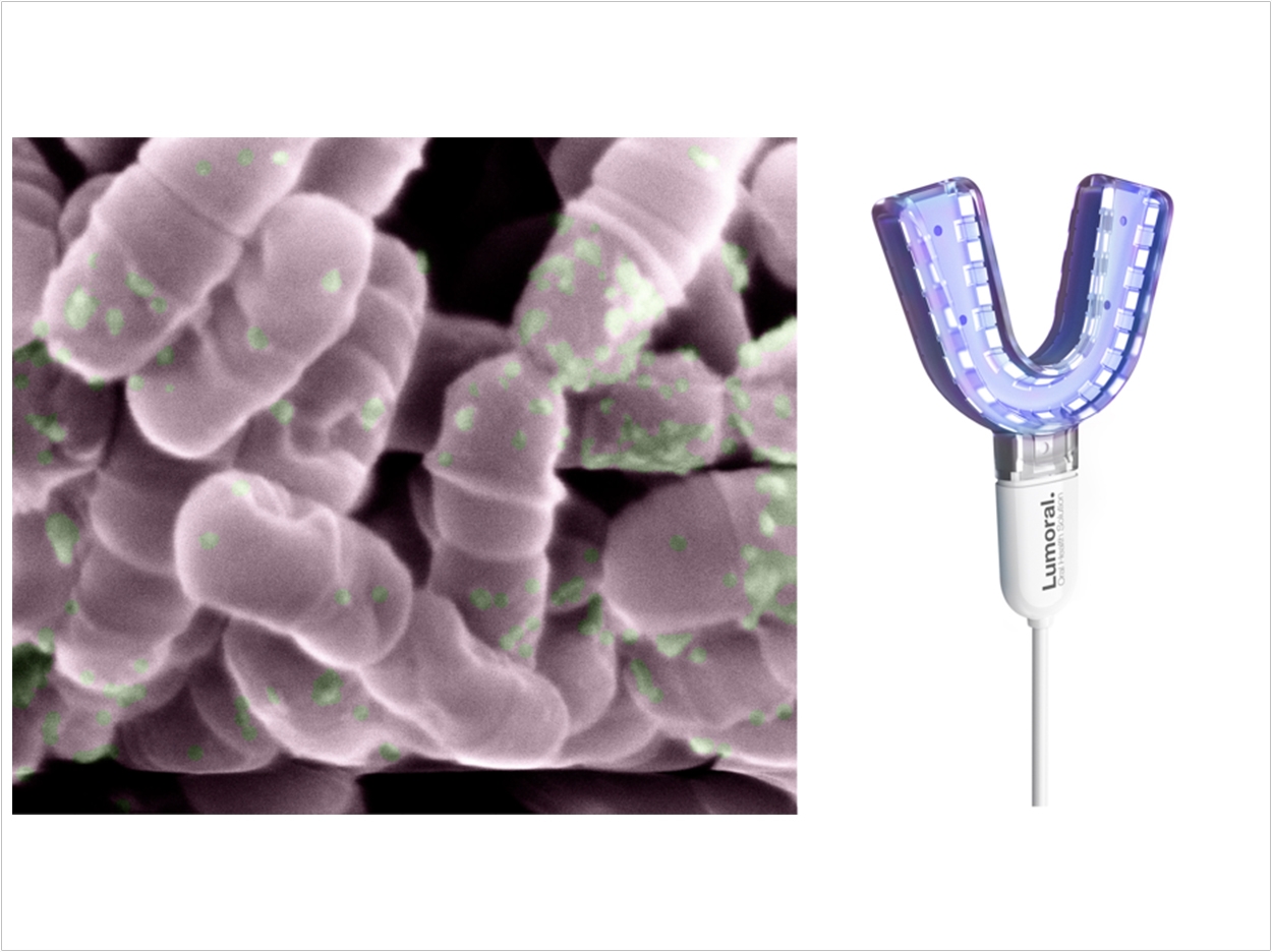 Left: An electron microscope image showing dead Streptococcus mutans bacteria with the new photosensitive mouthwash stuck to their surface. Right: The light activator. Photos: Koite Health.