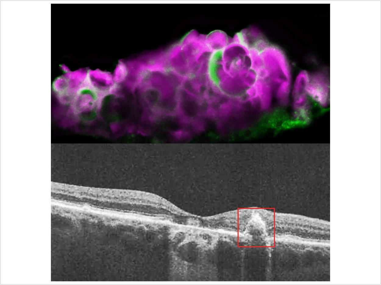 Top: HAP spherules (pink) and amelotin protein (green) in soft drusen from eye with dry AMD. Bottom: OCT image of eye with dry AMD, showing soft drusen beneath the retinal pigment epithelium. Dinusha Rajapakse, NEI