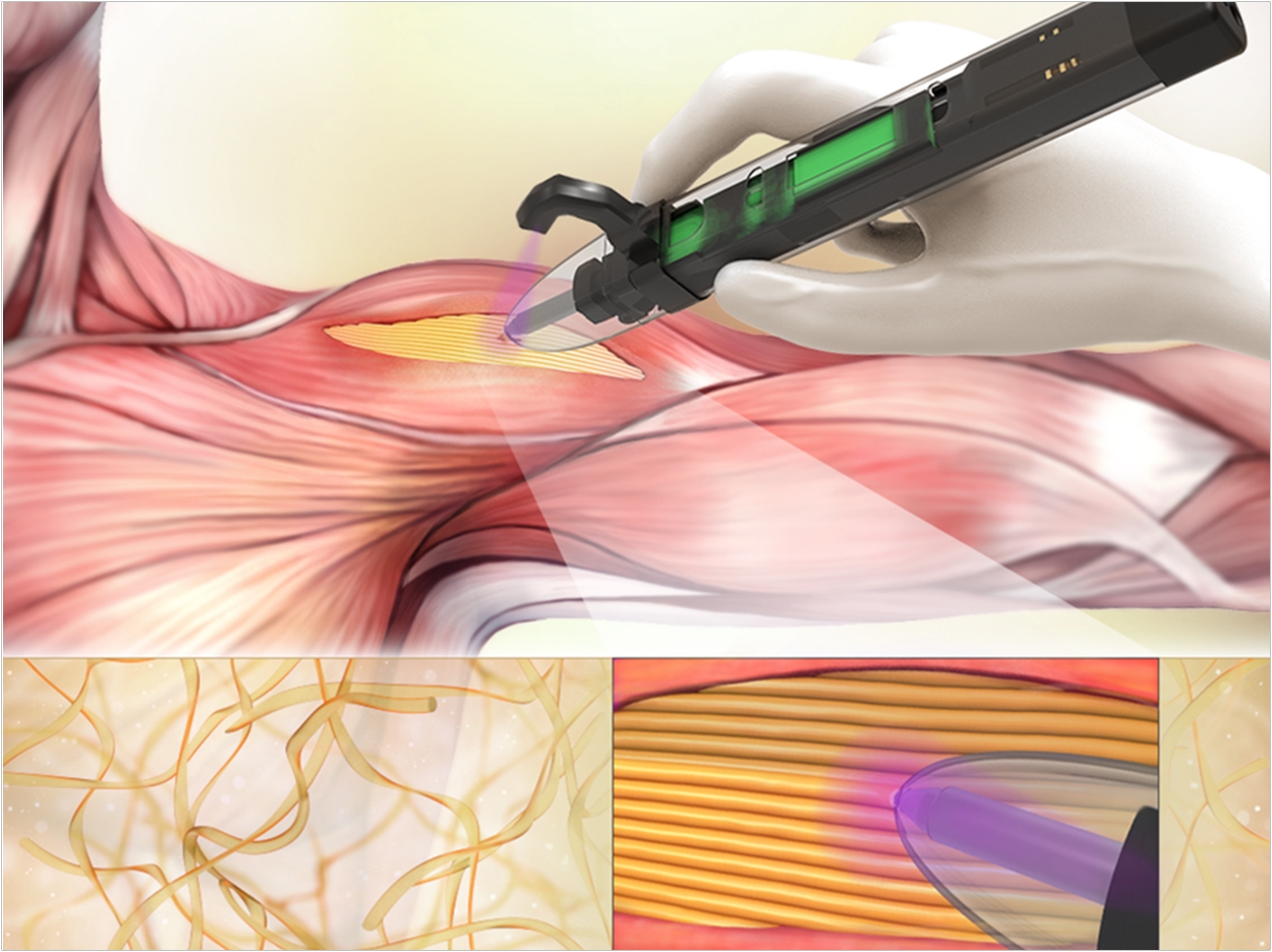 The bioprinter enables surgeons to deposit scaffolds—or materials to help support cellular and tissue growth—directly into the defect sites within weakened skeletal muscles.