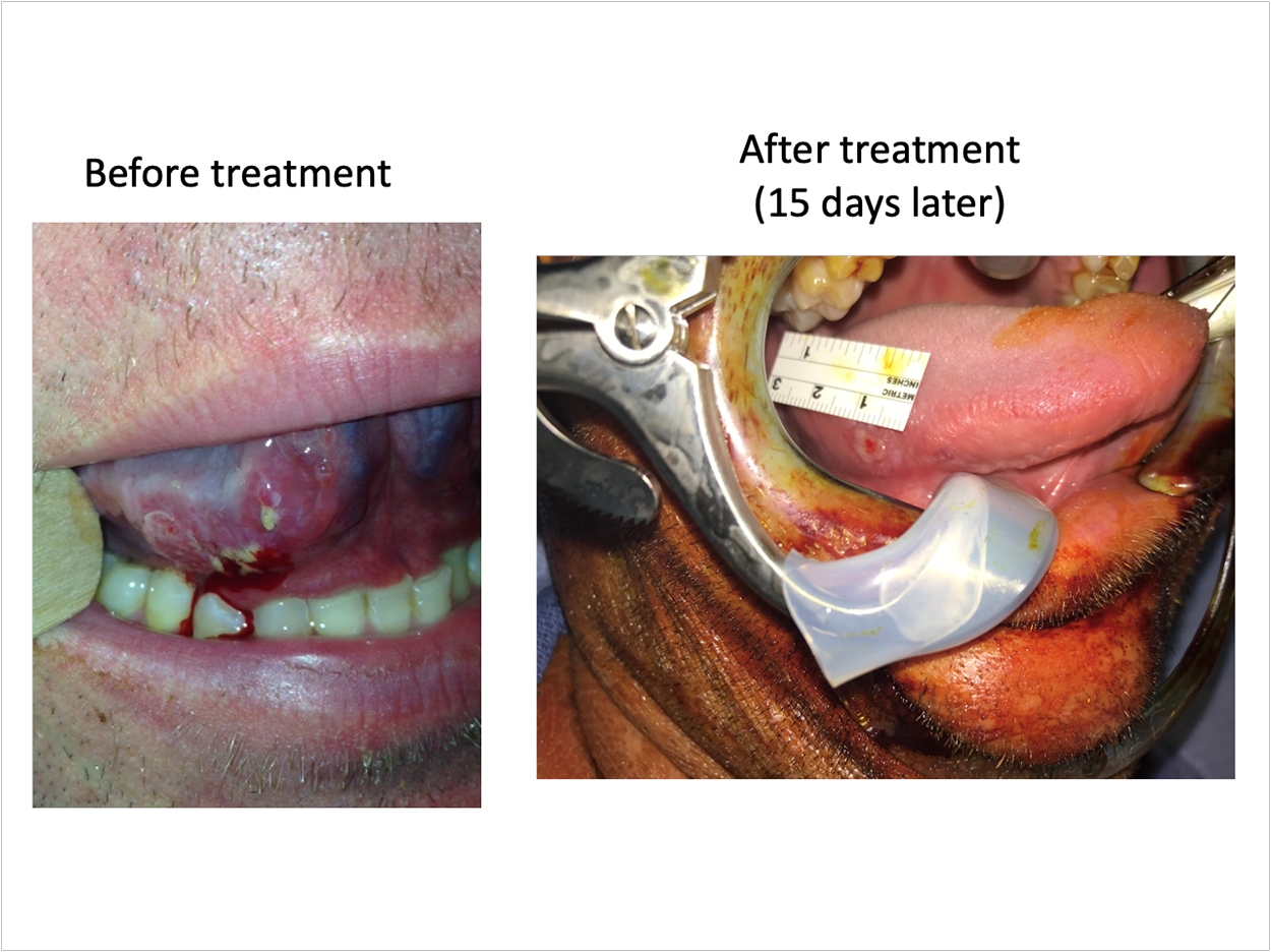 Pathologic complete response after Nivo + Ipi