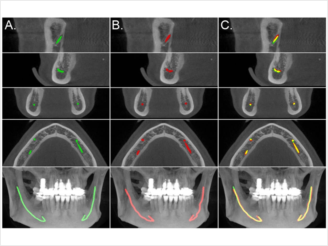 Comparison of the model segmentation and the ground truth, from the secondary test data annotations, for a CBCT scan.
