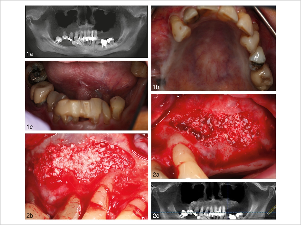Preoperative panoramic x-ray (1a). Maxillary arch occlusal view (1b). Mandibular arch frontal view (1c). Lateral window sinus augmentation on right side (2a). Lateral window sinus augmentation on left side (2b). Postoperative panoramic x-ray (2c). Courtesy of the Journal of Oral Implantology.
