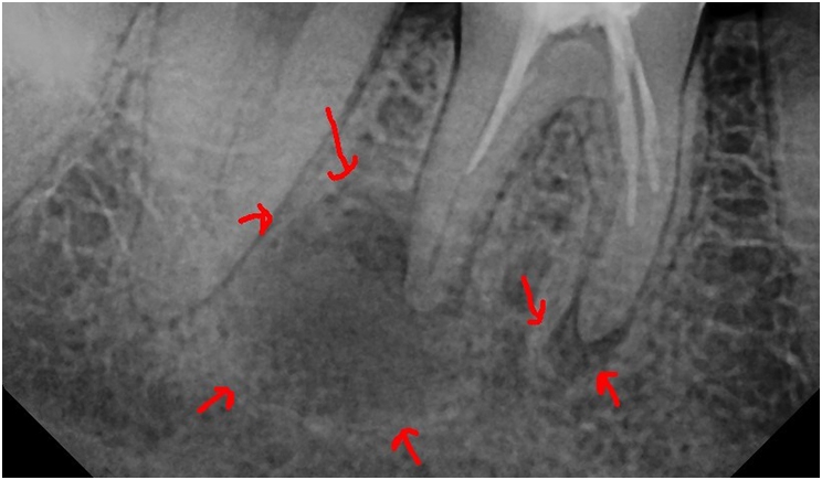 Figure 1. Tooth No. 30 had a previous root canal with inadequate cleaning, shaping, and obturation.