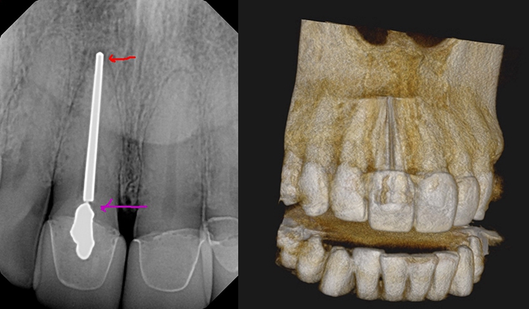 Figure 1. The pre-op on tooth No. 8 shows previous treatment with an over-extended silver point with a broken handle (left). I used a Carestream 8100 to provide an LFOV CBCT bone rendering right)