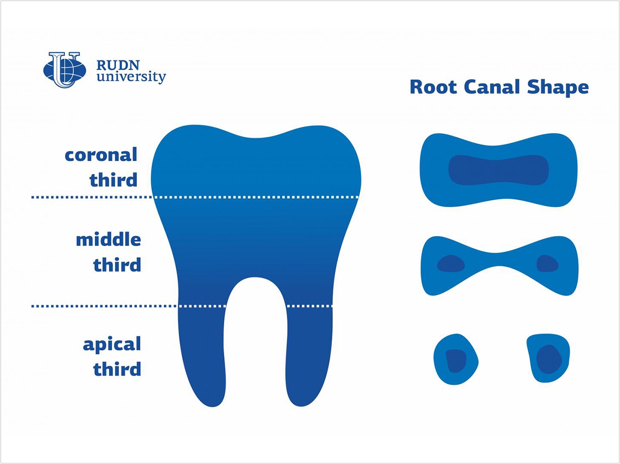Individual characteristics of the shape and cross-section of the root canal are one of the main issues for dentists. When treating a root canal, a doctor needs to properly clean it, fill it, and carry out a rebuilding procedure so that a canal is sealed. The first stage of endodontic treatment requires detailed knowledge of root canal anatomy. A team of dentists from RUDN University studied and classified various changes in root canal shapes. The new classification will help doctors avoid diagnostic errors, better select their tools, and treat patients more efficiently.