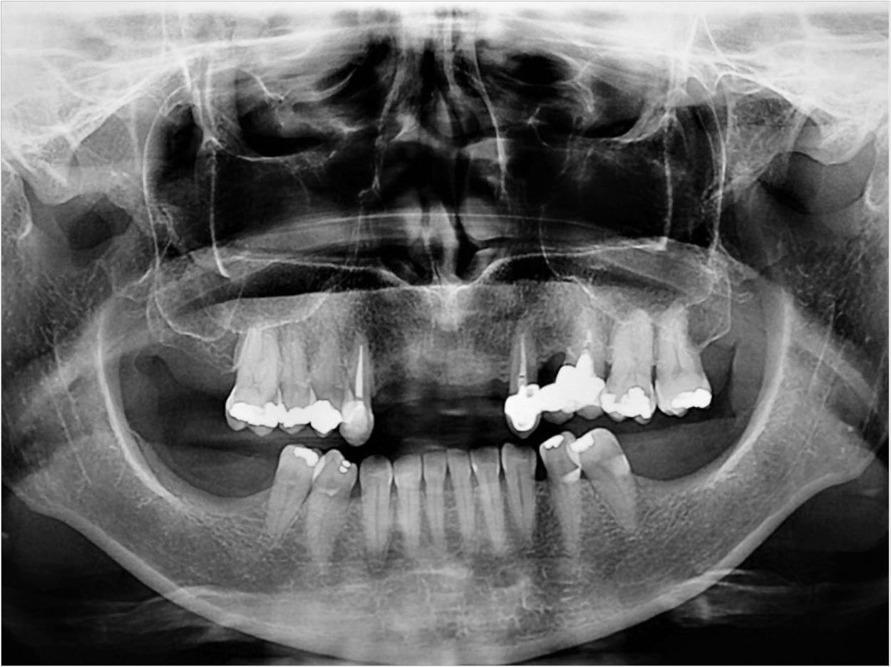 clinicians at the Bauru School of Dentistry and State University of Maringá in Brazil successfully treated a patient with low bone mass, also known as osteopenia, after a thorough review of the literature. Courtesy of the Journal of Oral Implantology