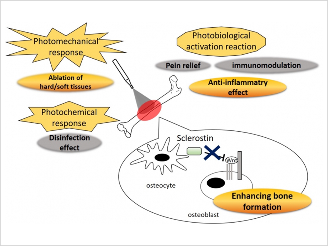 Laser irradiation causes photomechanical response, photobiological activation reaction, and photochemical response in the various tissues and cells. Downregulation of Sost expression in the bone tissue was observed after Er:YAG laser bone ablation. Because sclerostin (coded by Sost) suppressed bone formation by inhibiting canonical Wnt signaling pathway, there is a possibility that Er:YAG laser irradiation to the bone enhances bone formation. Department of Periodontology, TMDU