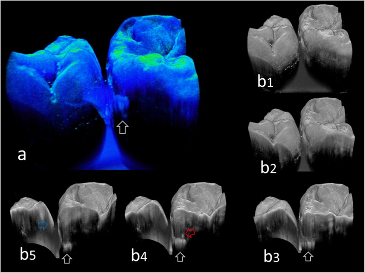 Pseudo-color 3-D OCT image of posterior teeth processed translucently (a). Presence of caries at the proximal surface was clearly imaged with the lesion location and size (white arrow). Sequential 2D images acquired in 3D view from different thickness (b1-b5). White arrows: caries within the enamel. Red arrow: dentin caries. Blue arrow: slight change of enamel surface because of caries.