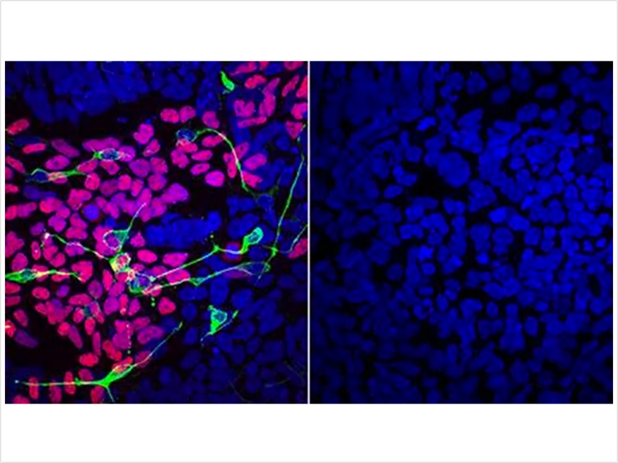 Compared to a disease-free mother (left), differentiated LINKED patient cells (right) lack markers of normal development of the brain, spinal cord and craniofacial skeleton (pink, green, and yellow).