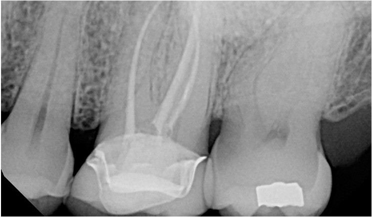 Figure 1. Preoperative image of tooth No. 14 with previous root canal treatment.