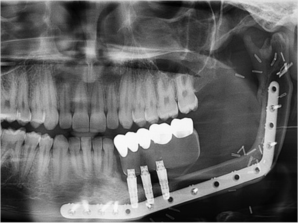 Courtesy of the Journal of Oral and Maxillofacial Surgery.