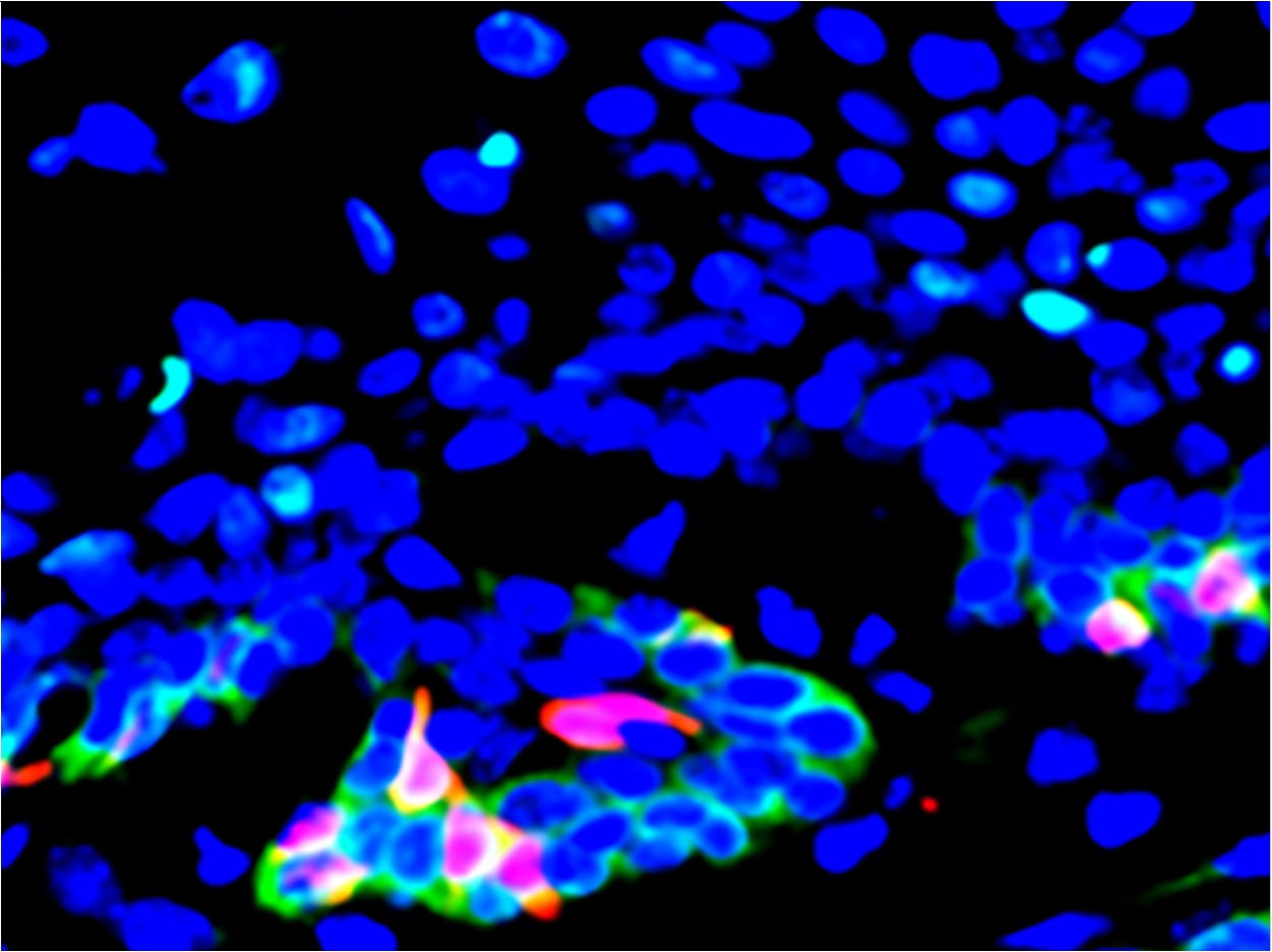 Head and neck cancer stem cells (red) expressing the CD276 gene (green) are found in high proportions at the periphery of tumor bodies; CD276 provides protection against cancer-fighting T cells to stem cells and interior tumor cells (blue).