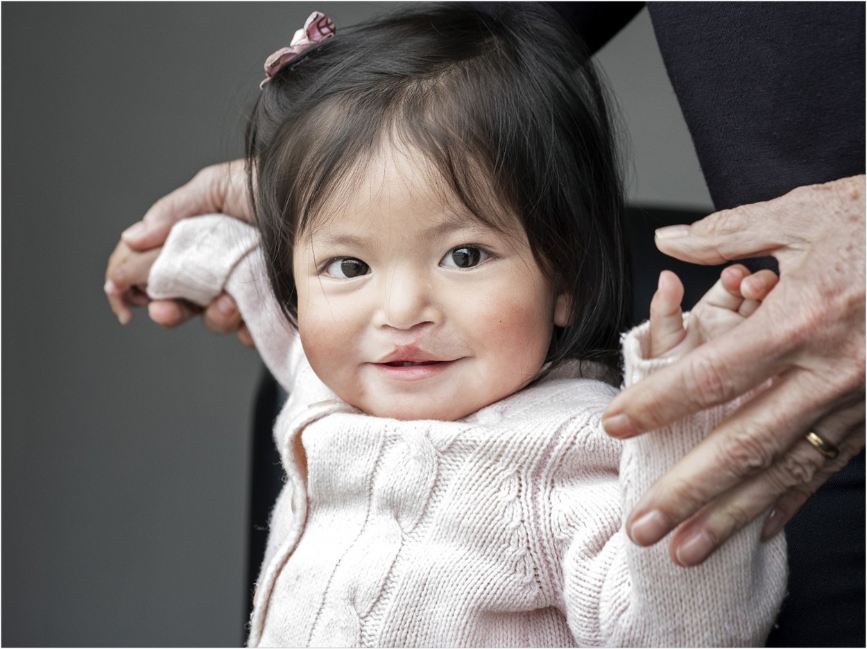 Annika, seen here seven months after surgery, is one of many beneficiaries of Operation Smile's services. Photo: Margherita Mirabella.