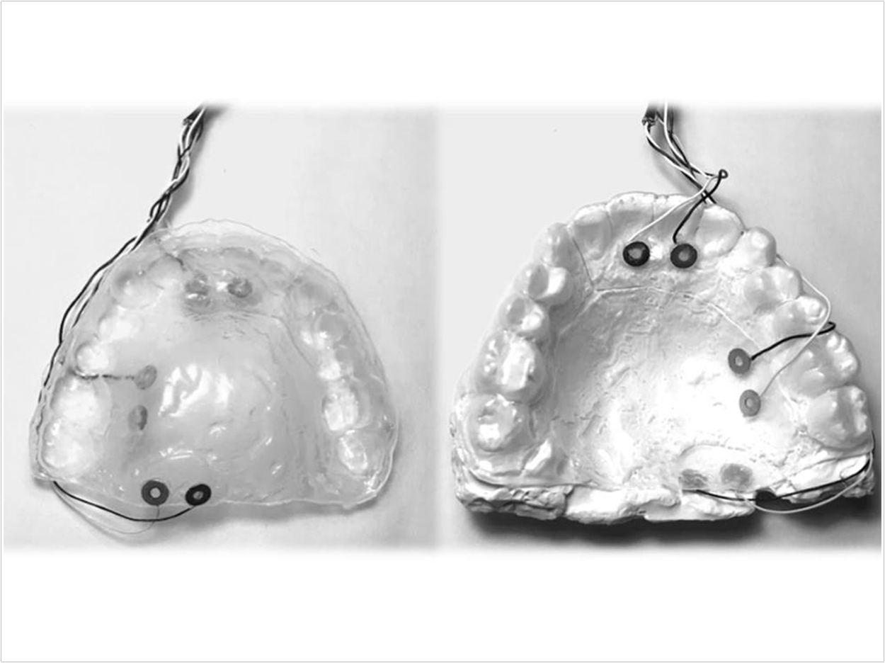 Top and bottom view of a retainer containing electrodes for intraoral electrical stimulation. Courtesy of Hangue Park