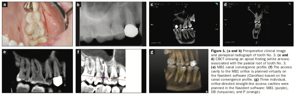 dynamic navigation, Endodontic access