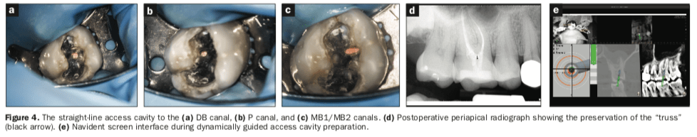 dynamic navigation, Endodontic access