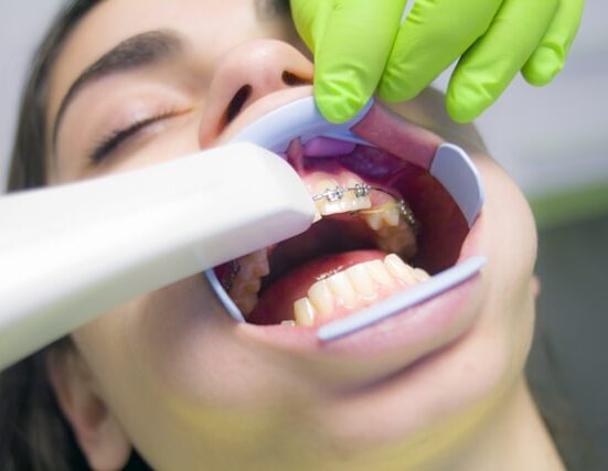 impression-less digital scanners