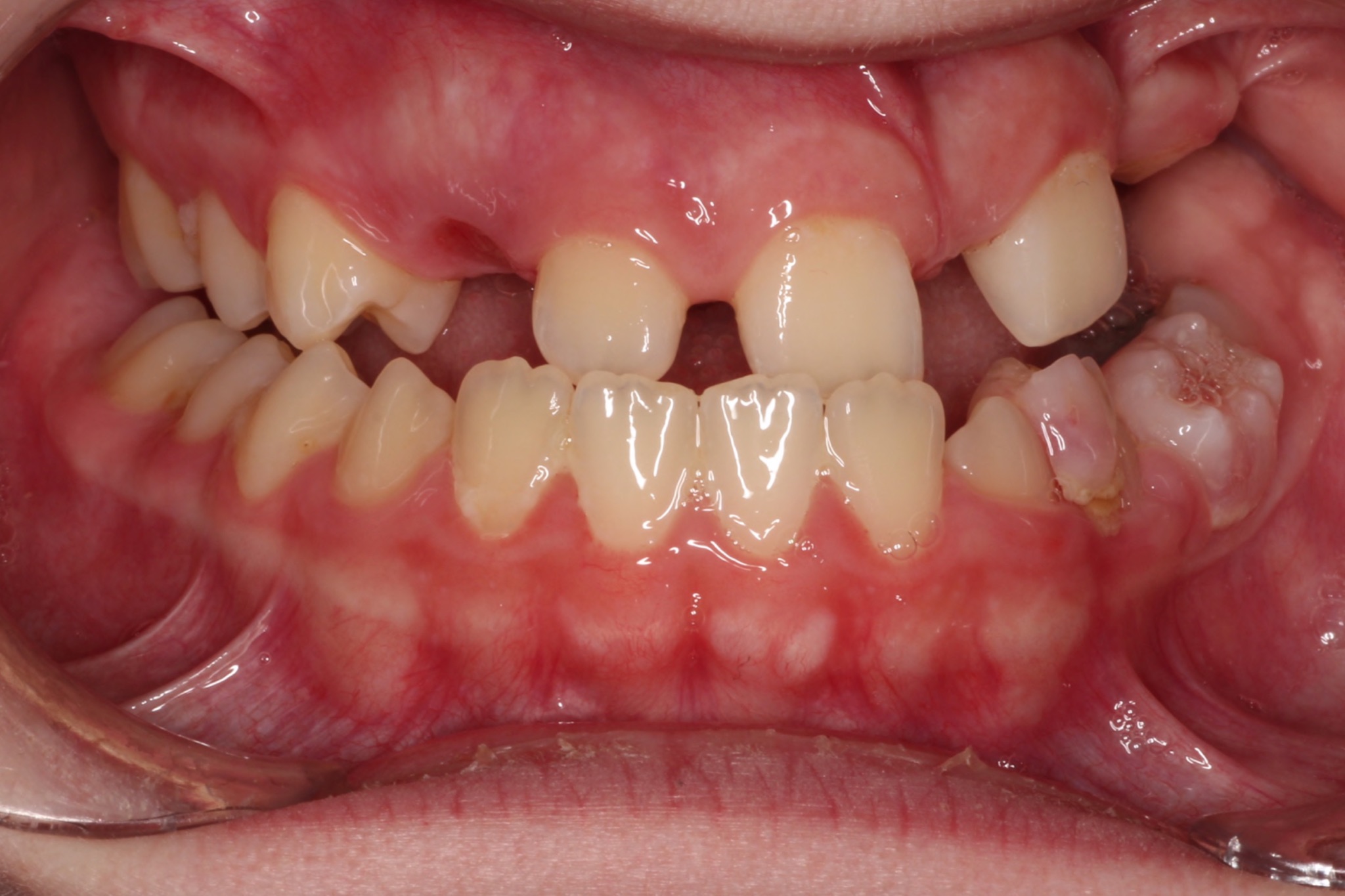 congenital growth defect