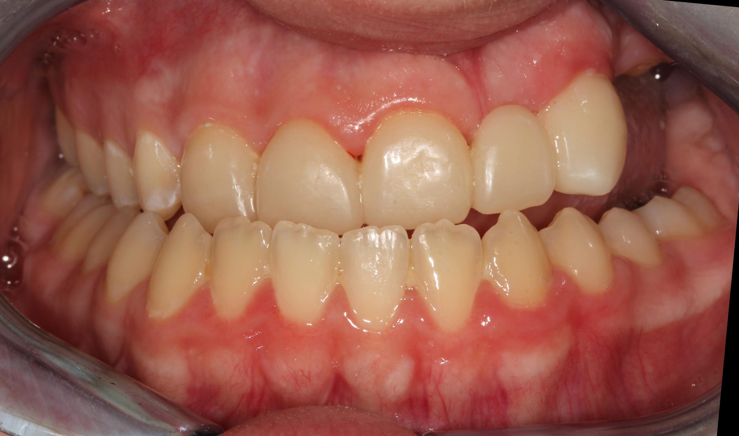 congenital growth defect