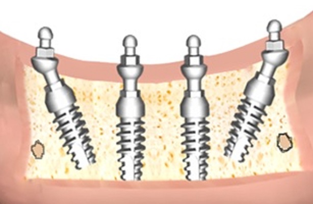 implant challenges, quantum implants