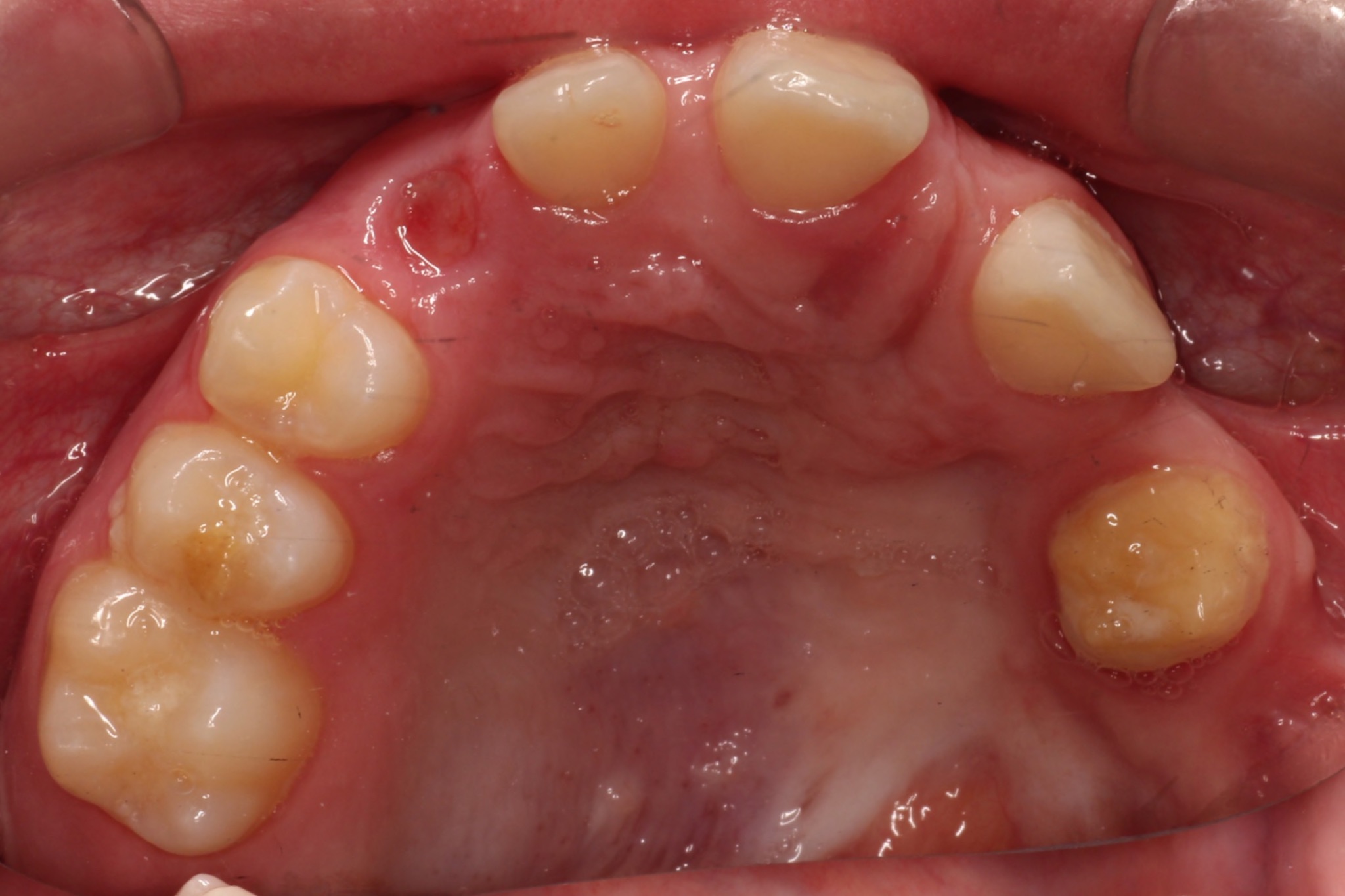 congenital growth defect