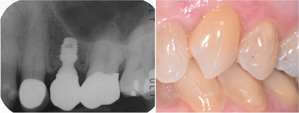 implant challenges, quantum implants