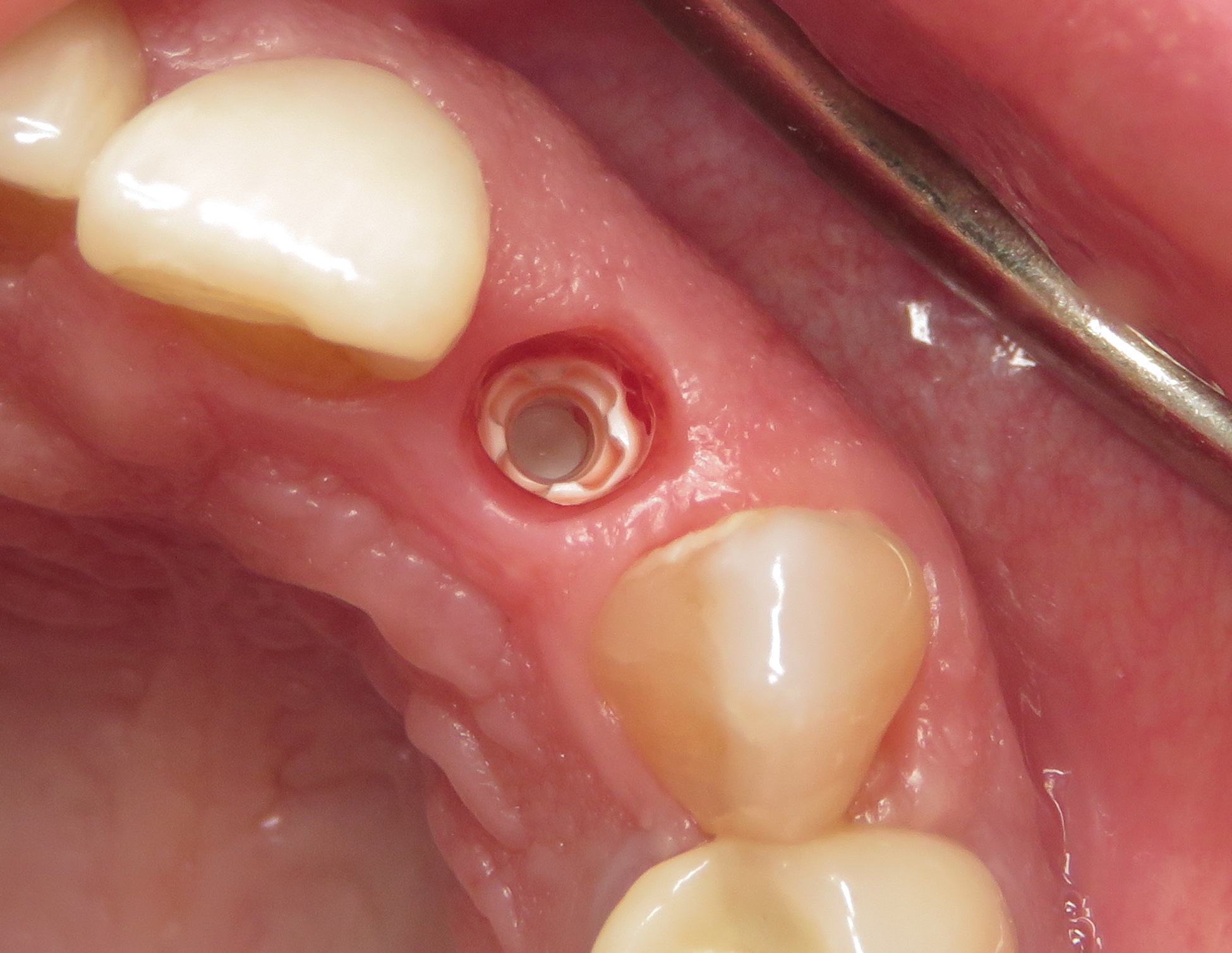ceramic dental implants