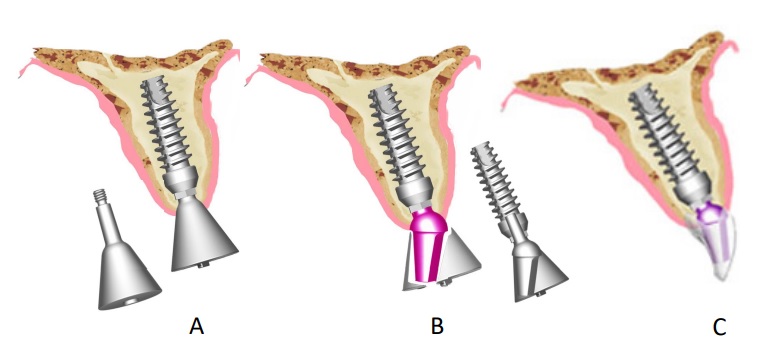 implant challenges