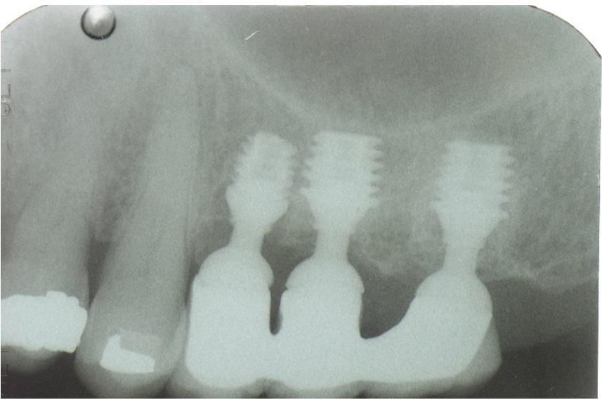 implant challenges, quantum implants