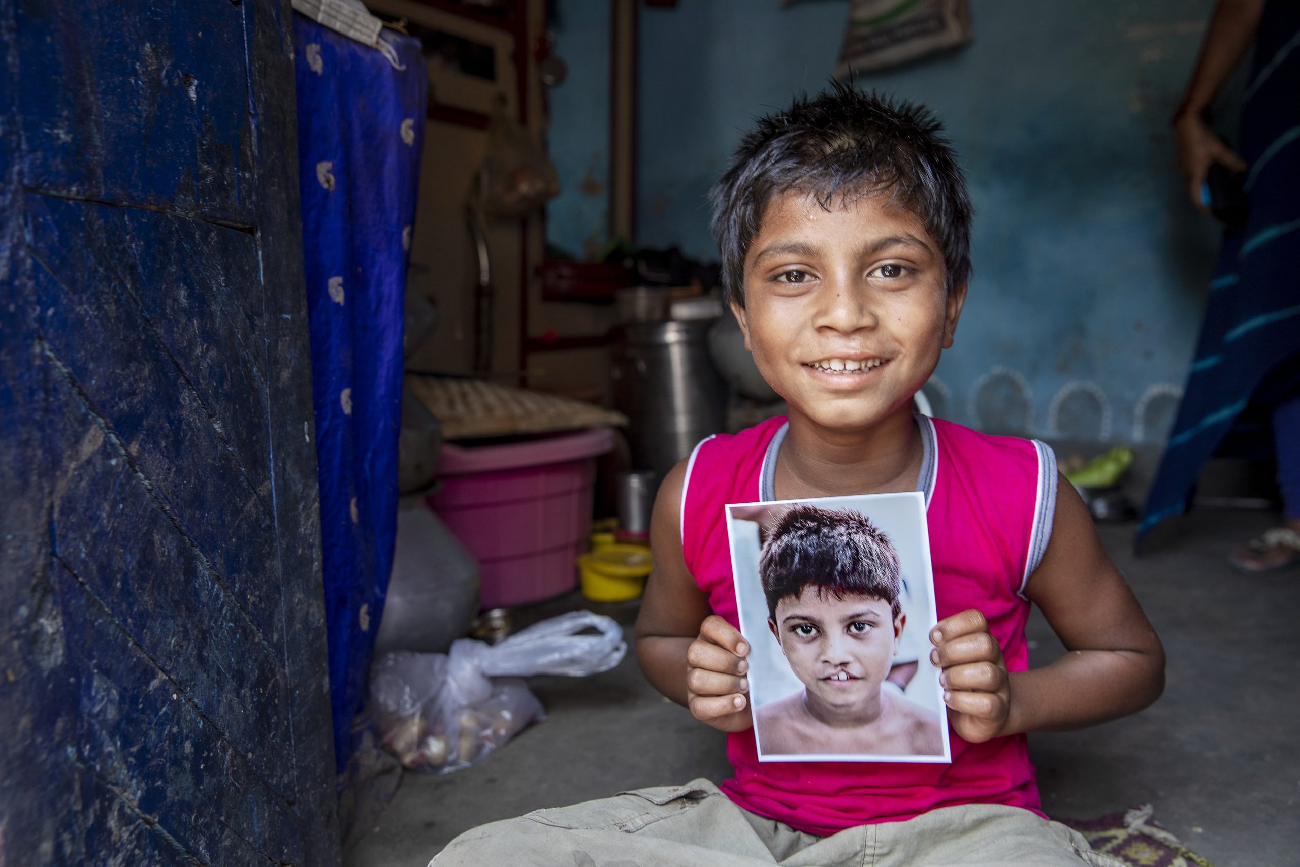 operation smile