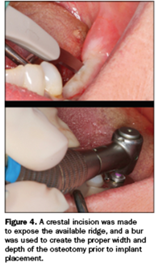 guided implant surgery